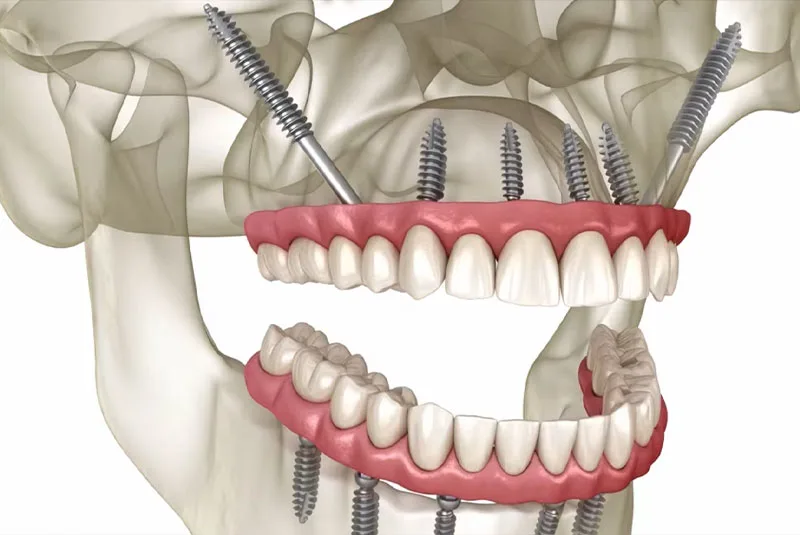 Ilustração anatômica do apoio dos implantes zigomáticos