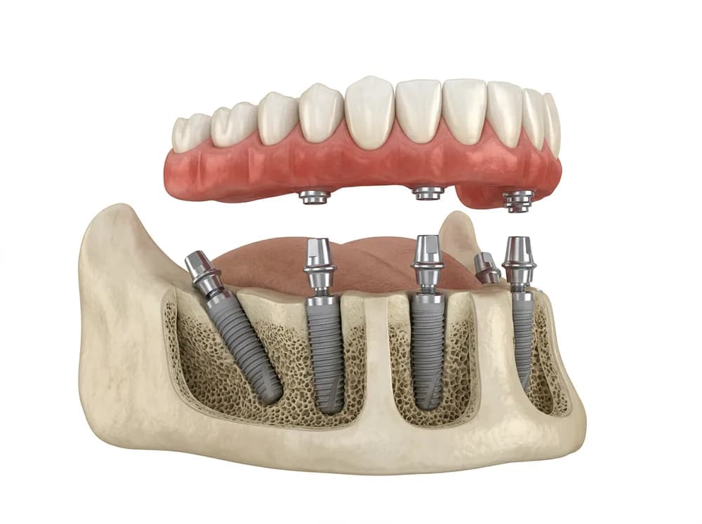 Ilustração de uma prótese completa apoiada sobre implantes